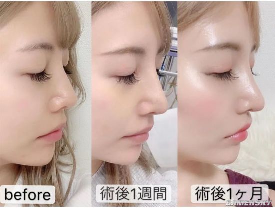 号称日本最美“整容双胞胎” 公开整容前照片自嘲黑历史